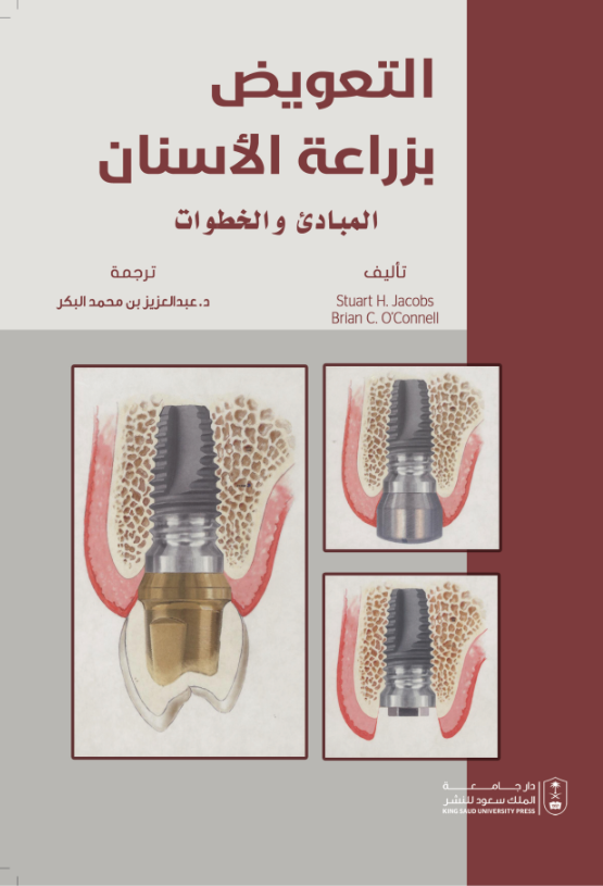 التعويض بزراعة الأسنان المبادئ والخطوات