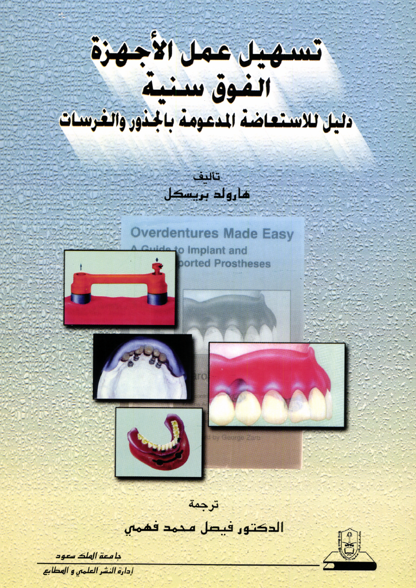 تسهيل عمل الأجهزة الفوق سنية: دليل للاستعــاضــــة المدعومة بالجــذور والغــرســـات