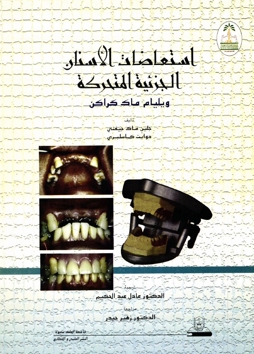 استعاضات الأسنان الجزئية المتحركة