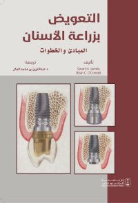 التعويض بزراعة الأسنان المبادئ والخطوات