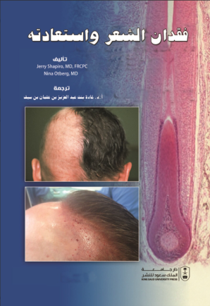 فقدان الشعر واستعادته